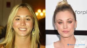 10 Celebrity Rhinoplasty Results