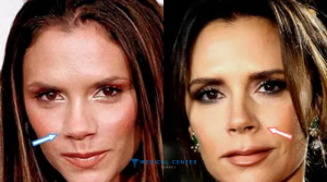 10 Celebrity Rhinoplasty Results