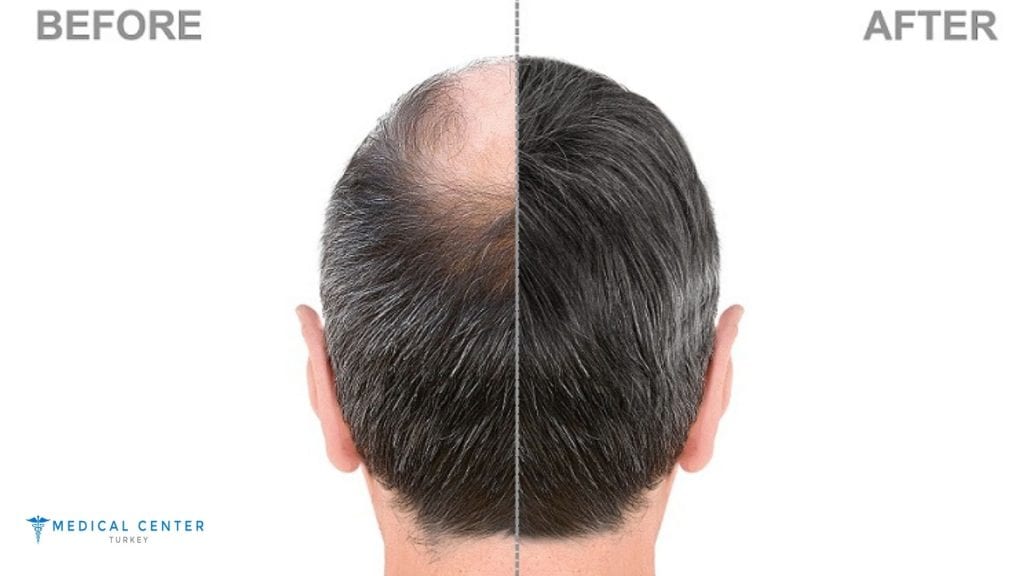3 Brothers Hair Transplant Journey in İstanbul