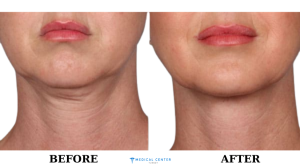 A 2025 Solution for a Youthful Neckline