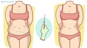 A Comprehensive Guide to Fat Injection Procedures in 2025