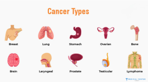 Affordable Cancer Treatment: Cost Advantages of Treatment in Turkey