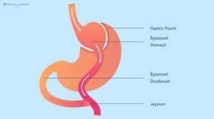 Are Bariatric Surgeries Popular Among Medical Tourists in 2025?