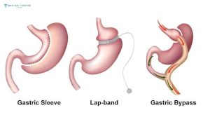 Are Bariatric Surgeries Popular Among Medical Tourists in 2025?