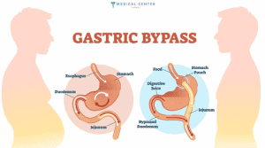 Are You Eligible for Gastric Bypass Surgery?
