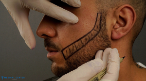 Beard Transplant Cost Turkey 