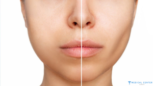Bichectomia 2025 What You Need to Know About Facial Sculpting