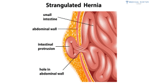 Bilateral Inhernia Surgery