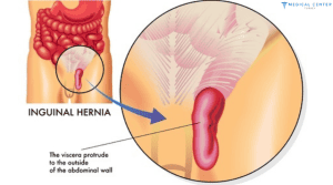 Bilateral Inguinal Hernia Surgery