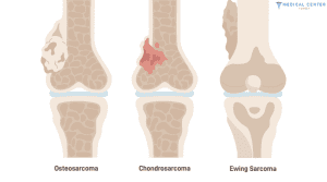 Bone Cancer