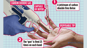 Botox for Hand Sweat