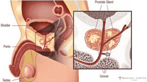 Brachytherapy for Prostate Cancer