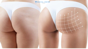 Brazilian Butt Lift in Turkey 2025