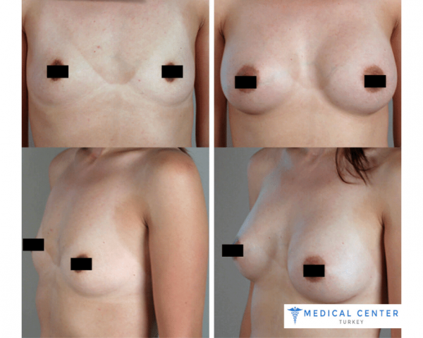Breast Augmentation Reviews in Turkey