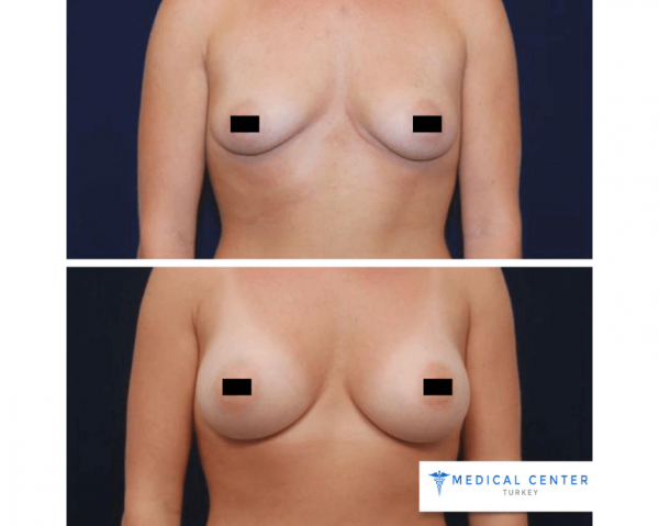 Breast Augmentation Reviews in Turkey