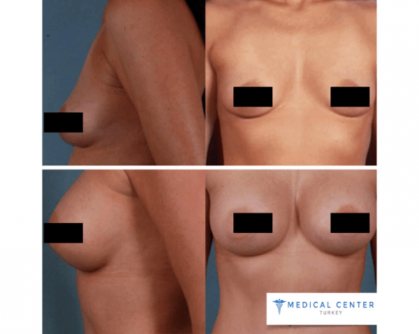 Breast Augmentation Reviews in Turkey