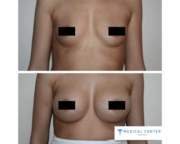Breast Augmentation Reviews in Turkey