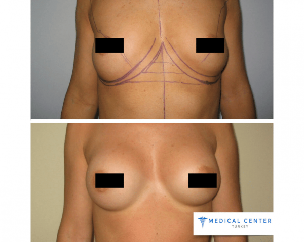 Breast Augmentation Reviews in Turkey
