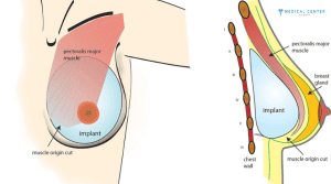 Breast Augmentation Understanding Different Implant Options