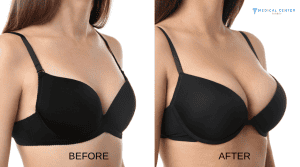 Breast Augmentation Understanding Different Implant Options