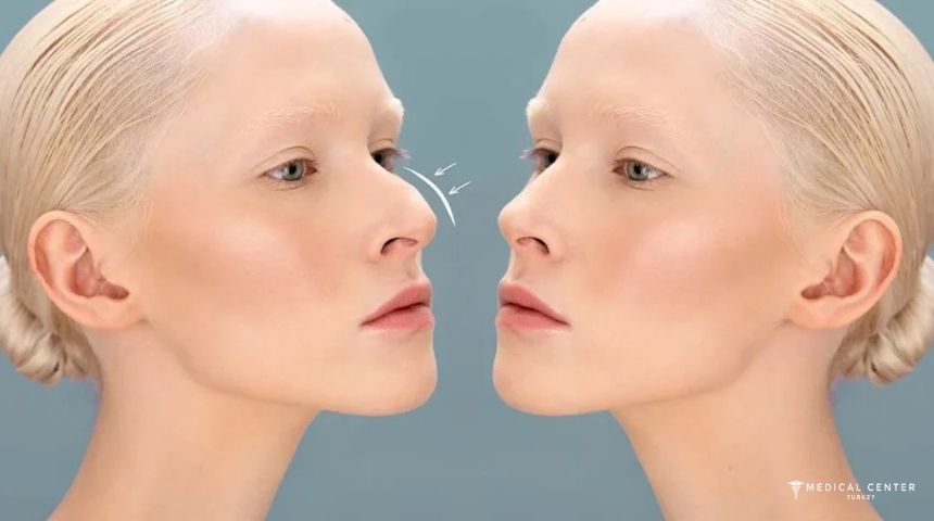 Cheapest Countries For Nose Job