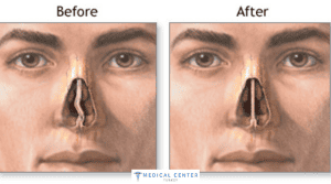 Cheapest Countries For Nose Job
