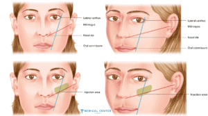 cheekbone fillers