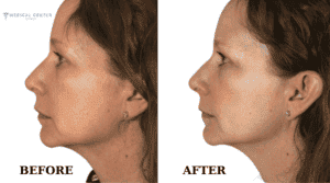 cheekbone fillers