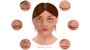 cheekbone fillers
