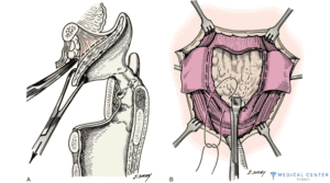Chemotherapy for larynx cancer