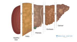 Chemotherapy for Liver Cancer 1