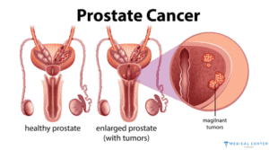 CHEMOTHERAPY FOR PROSTATE CANCER