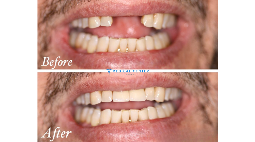 Choosing the Right Dental Treatment Abroad in 2025