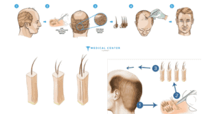 Choosing the Right Hair Transplant Surgeon: in Turkey