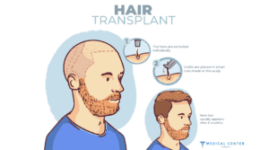 Choosing the Right Hair Transplant Surgeon: in Turkey