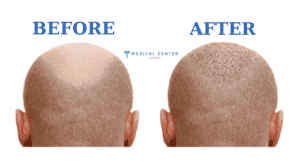 Choosing the Right Hair Transplant Surgeon: in Turkey