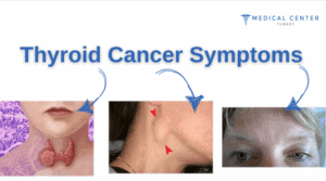 Complex Treatment for Thyroid Cancer
