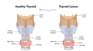 Complex Treatment for Thyroid Cancer 