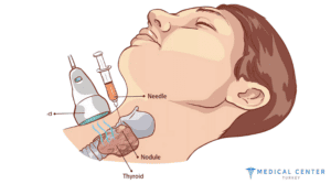 Complex Treatment for Thyroid Cancer 1