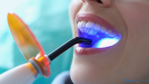 Cost of Dental Whitening for a Brighter Smile in Turkey 2025