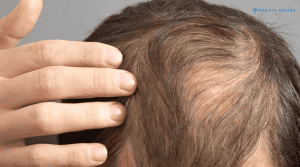 Daniel's Hair Transplant Experience in Turkey