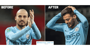 David Silva's Hair Transplantation