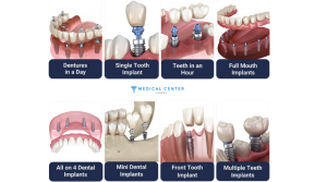 Dental Implants in Turkey Types, Prices, Procedures 