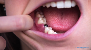 Dental Implants in Turkey 