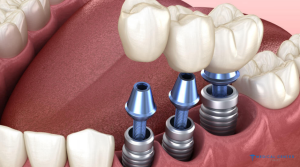Dental Implants in Turkey Types, Prices, Procedures (2)