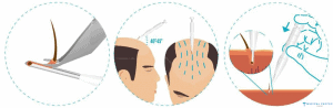 DHI Plus Gold Hair Transplantation in Turkey