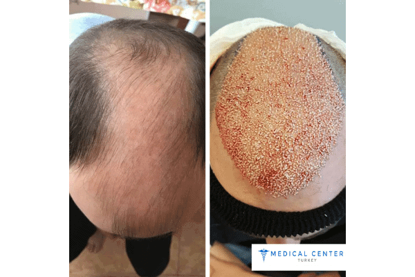 DHI vs. FUE: Hair Transplant Procedures