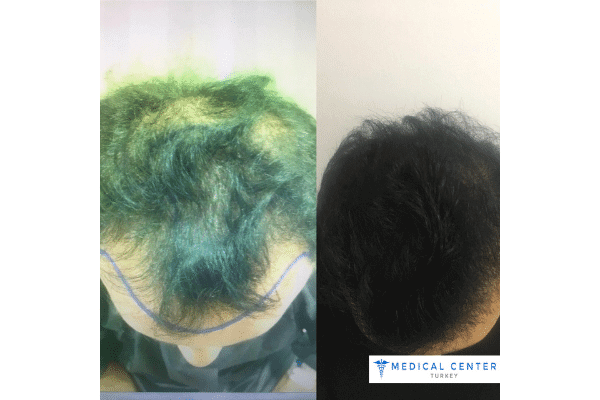 DHI vs. FUE: Hair Transplant Procedures