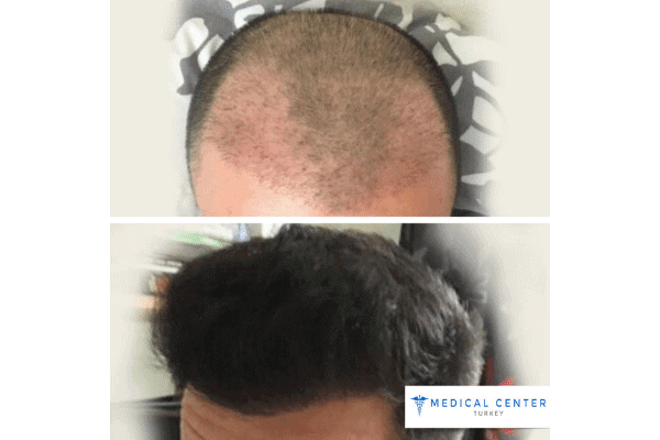 DHI vs. FUE: Hair Transplant Procedures