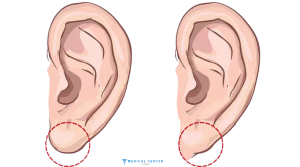 Earring Hole Repair Surgery in Turkey 2025